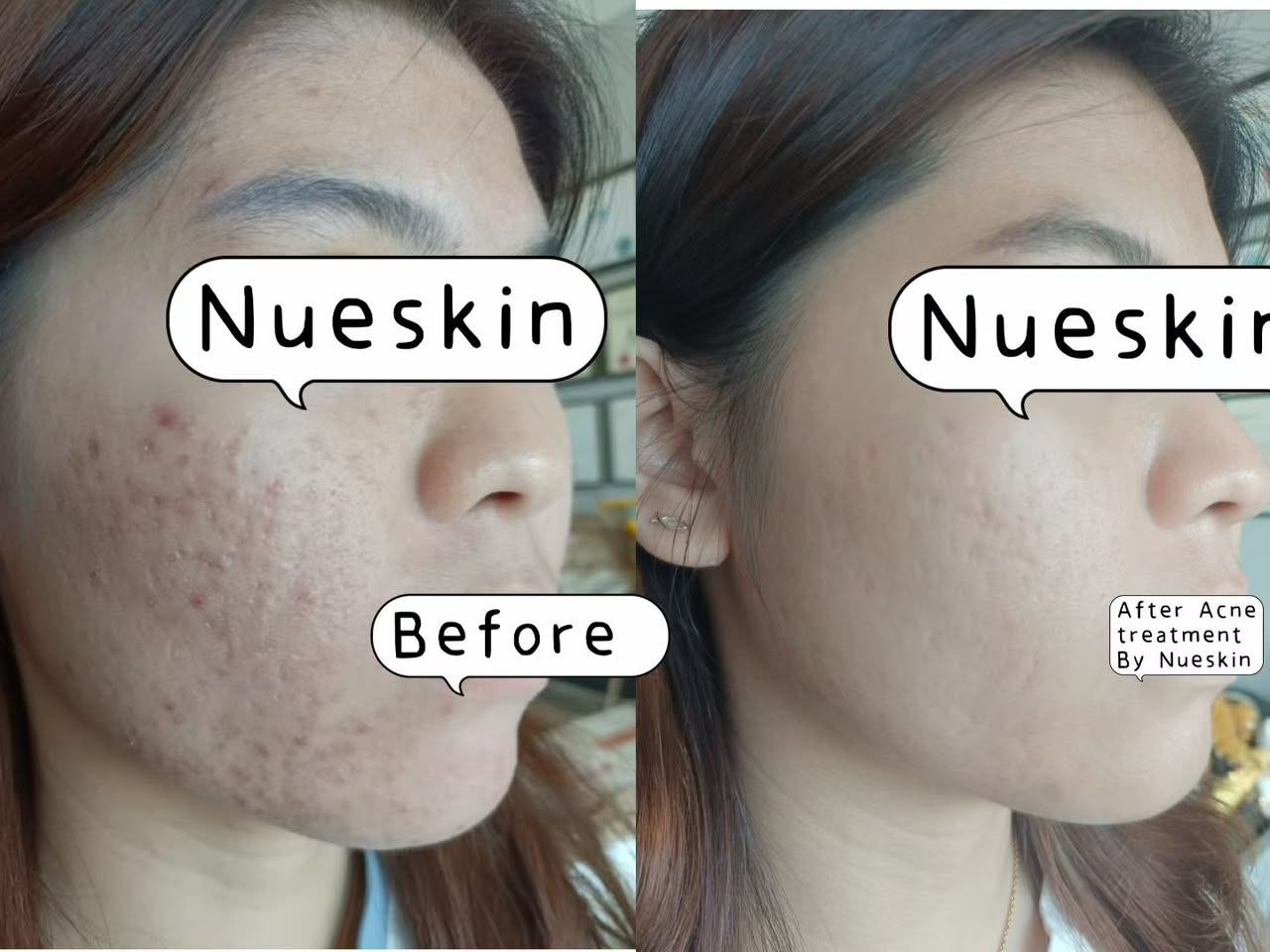 Acne Treatment before and after — Nue Skin Beauty Esthetique