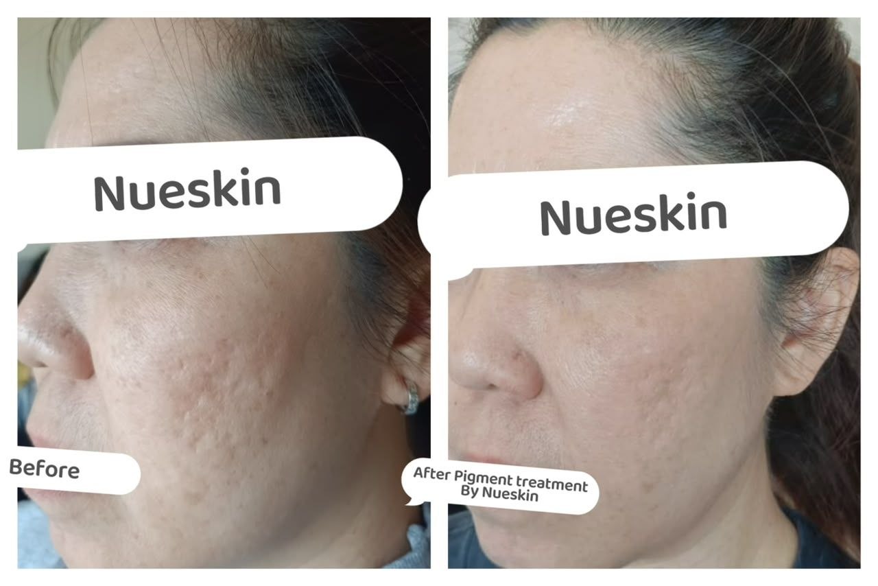 Acne Treatment before and after — Nue Skin Beauty Esthetique