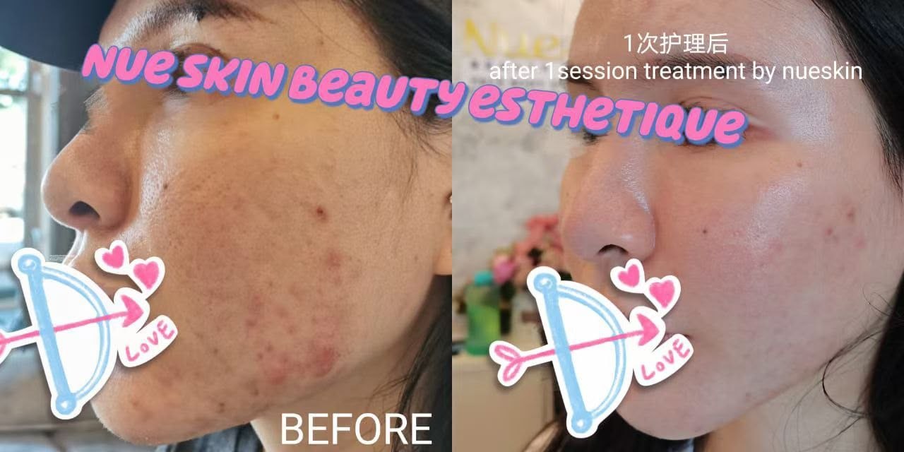 Acne Treatment before and after — Nue Skin Beauty Esthetique