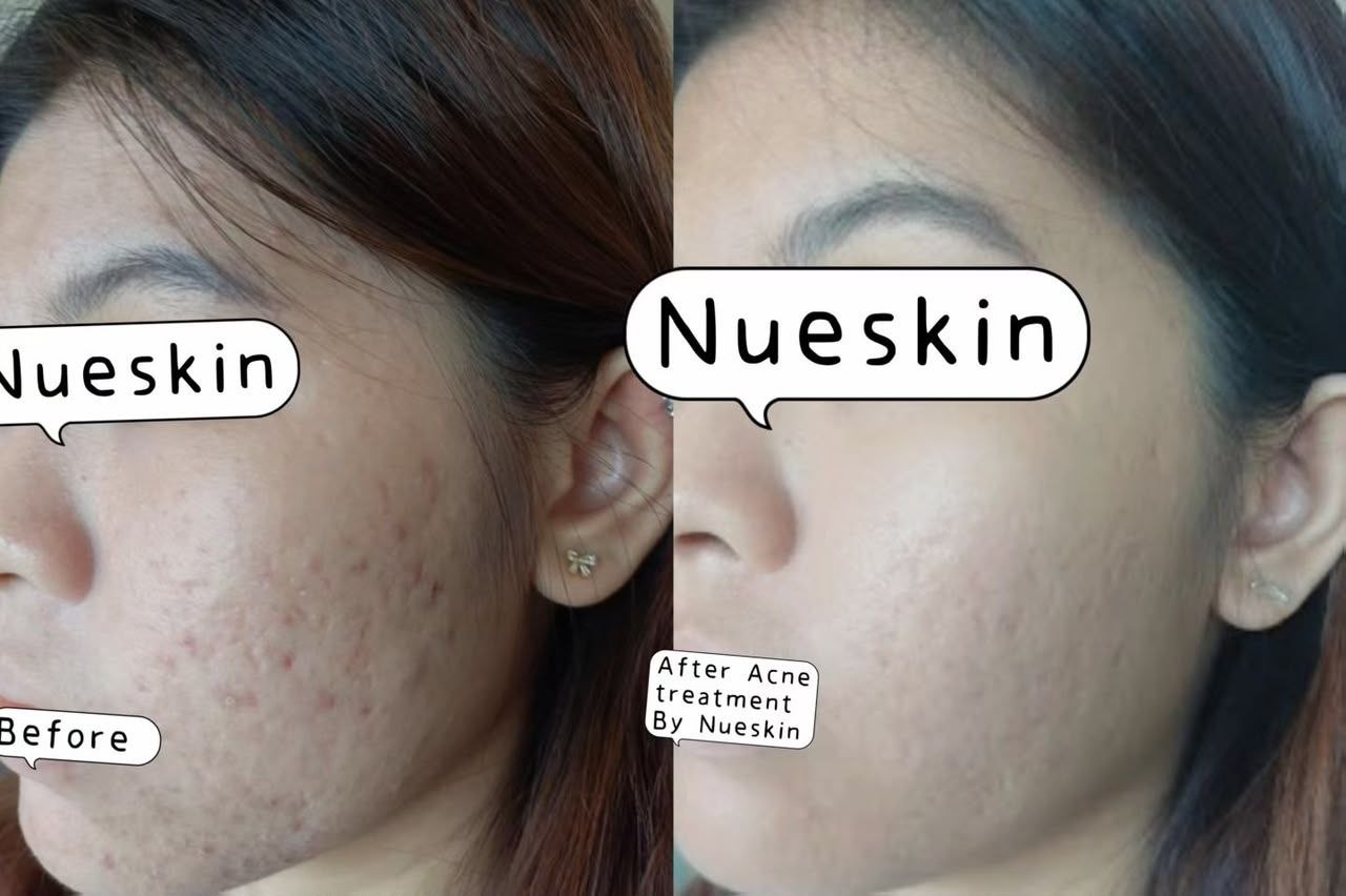 Acne Treatment before and after — Nue Skin Beauty Esthetique