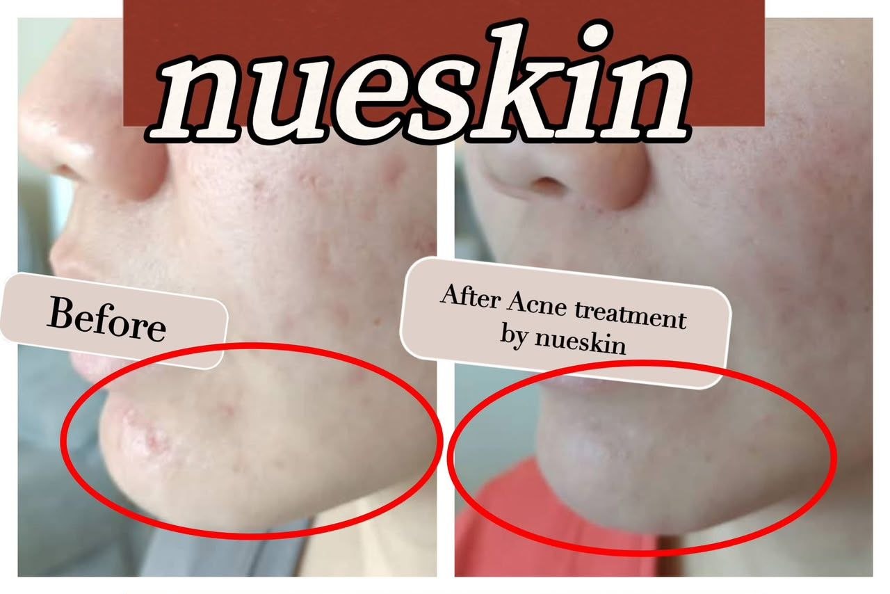 Acne Treatment before and after — Nue Skin Beauty Esthetique