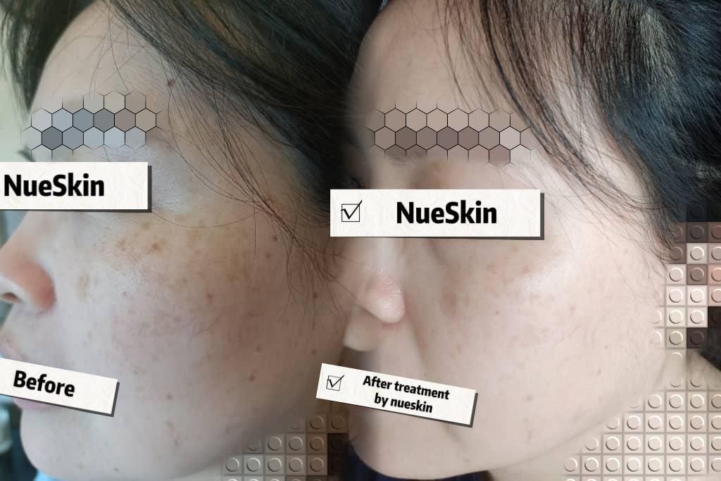 Acne Treatment before and after — Nue Skin Beauty Esthetique