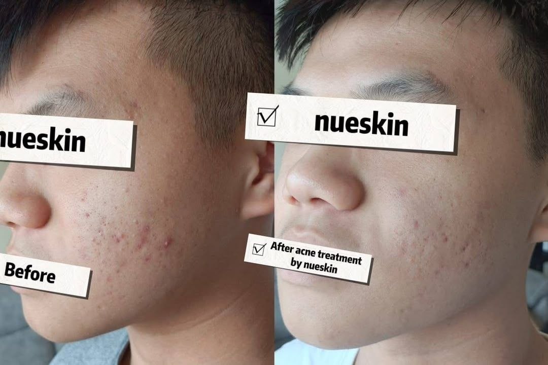 Acne Treatment before and after — Nue Skin Beauty Esthetique