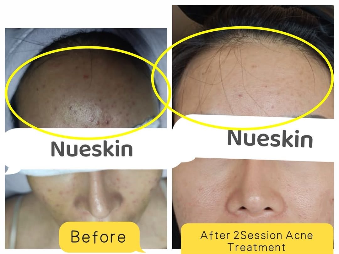 Acne Treatment before and after — Nue Skin Beauty Esthetique