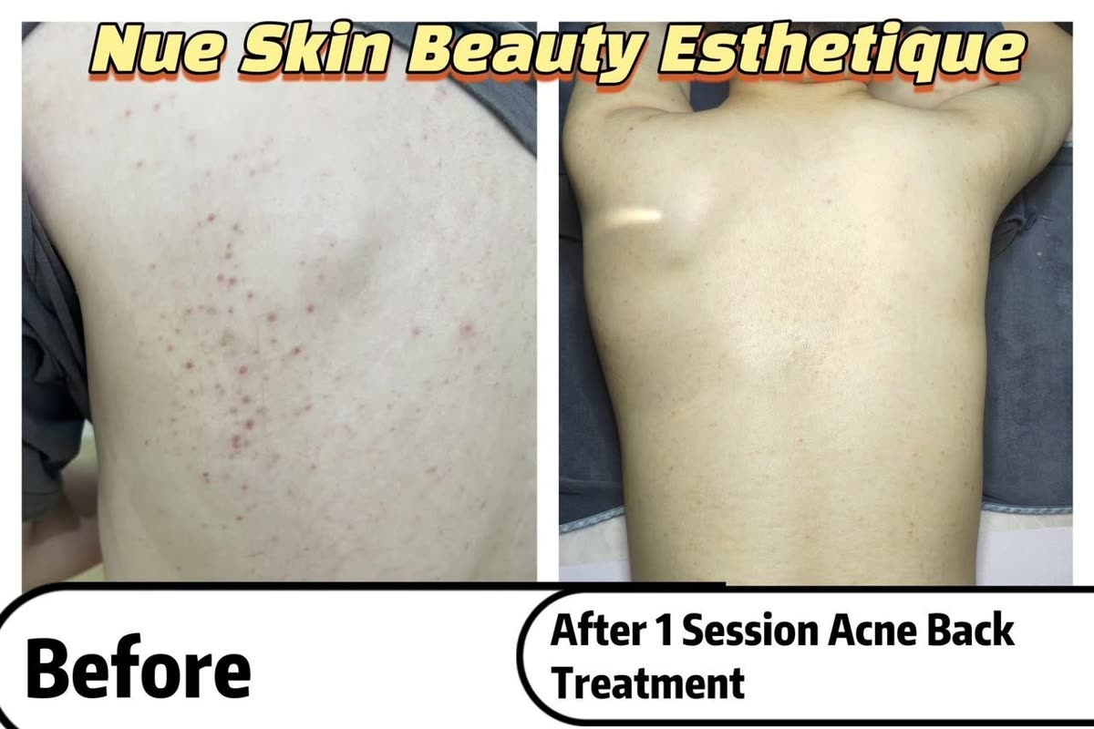 Acne back treatment chest results before and after — Nue Skin Beauty Esthetique