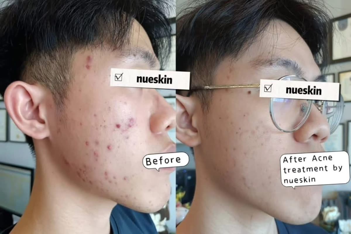 Acne treatment on cheek and jaw before and after — Nue Skin Beauty Esthetique