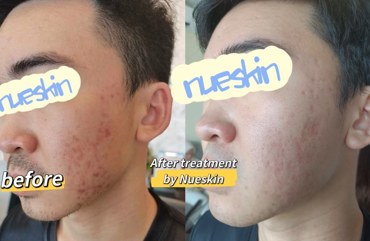 Acne and redness treatment on cheek and jaw before and after — Nue Skin Beauty Esthetique