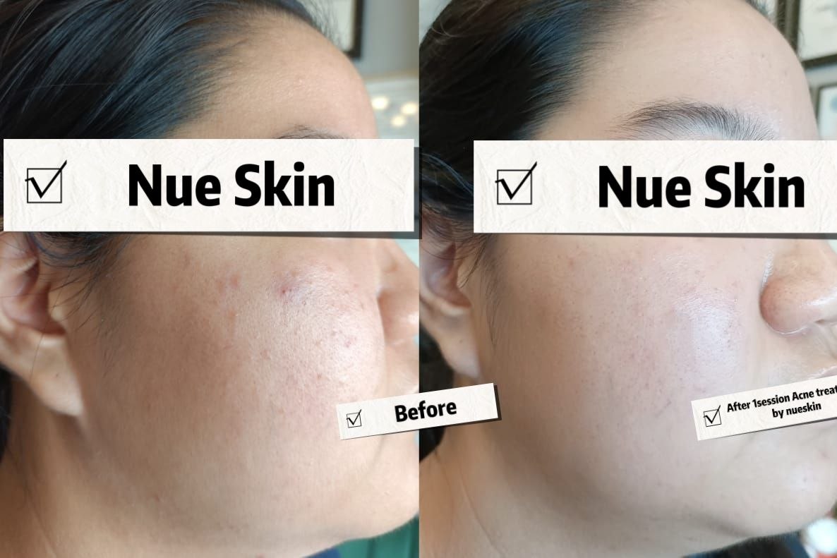 Acne treatment on cheek after one session — Nue Skin Beauty Esthetique