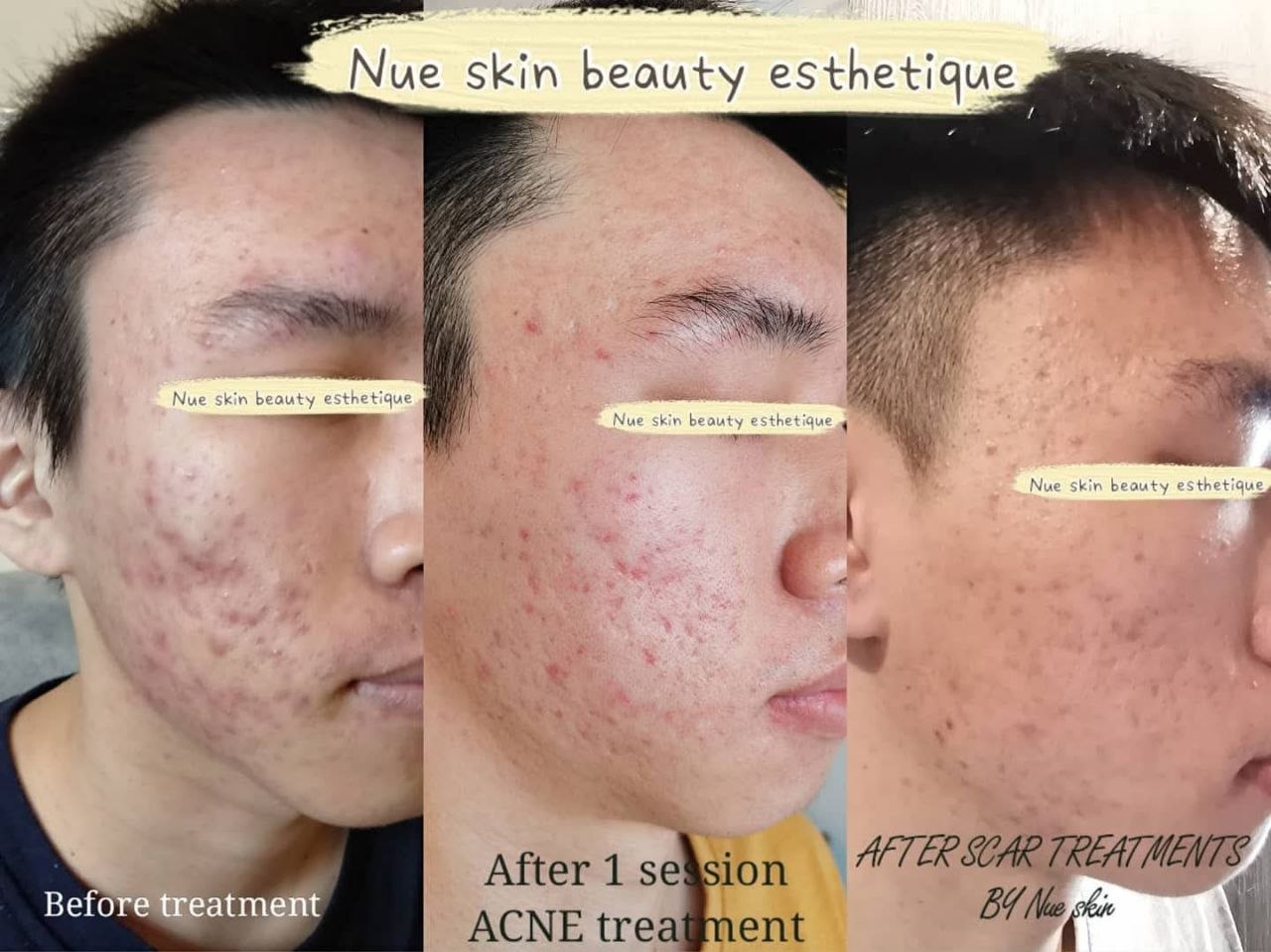 Acne & Scar Programme before and after — Nue Skin Beauty Esthetique