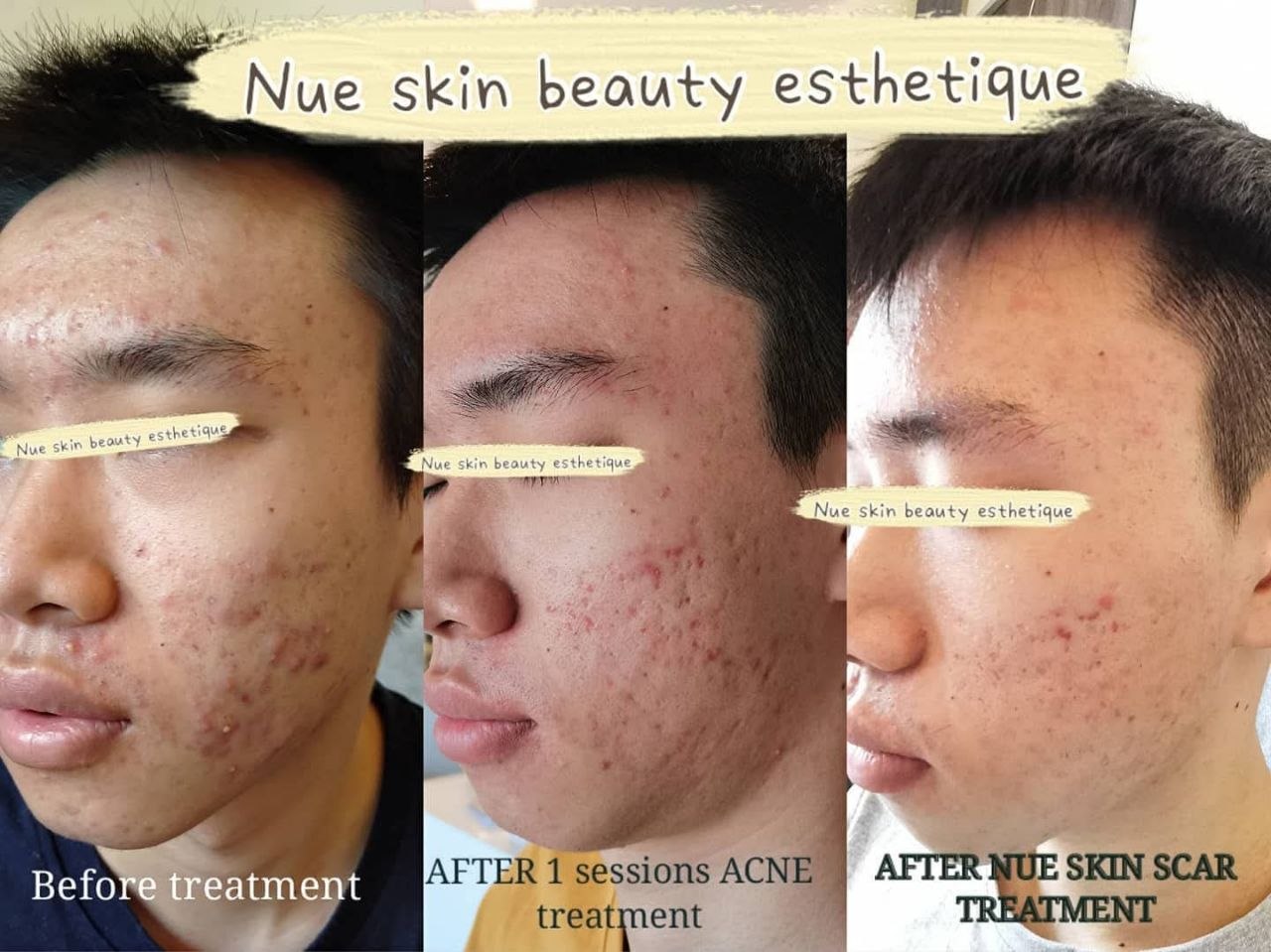 Acne & Scar Programme before and after — Nue Skin Beauty Esthetique
