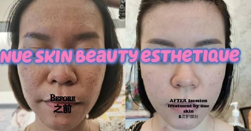 Acne & Scar Programme before and after — Nue Skin Beauty Esthetique