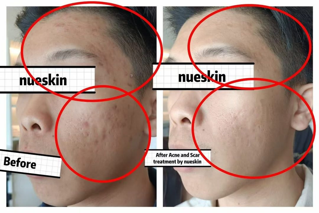 Scar Treatment before and after — Nue Skin Beauty Esthetique