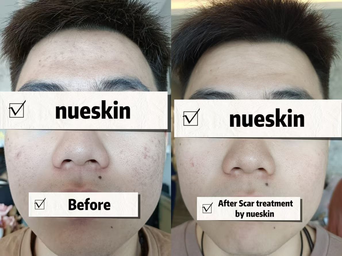 Scar Treatment before and after — Nue Skin Beauty Esthetique