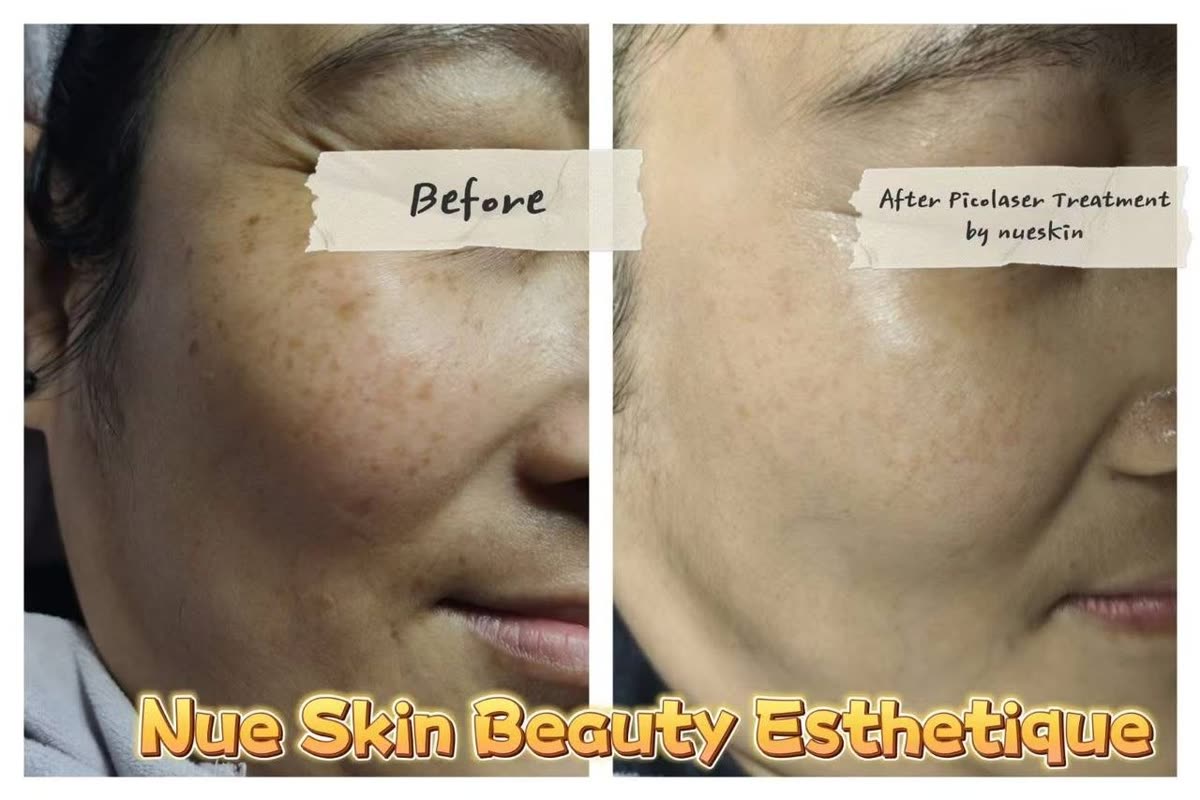 Acne treatment temple and cheek area before and after — Nue Skin Beauty Esthetique