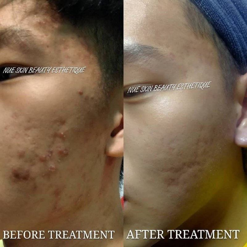 Acne Treatment before and after — Nue Skin Beauty Esthetique