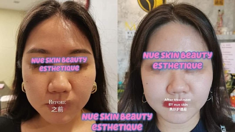 Brightening Treatment before and after — Nue Skin Beauty Esthetique