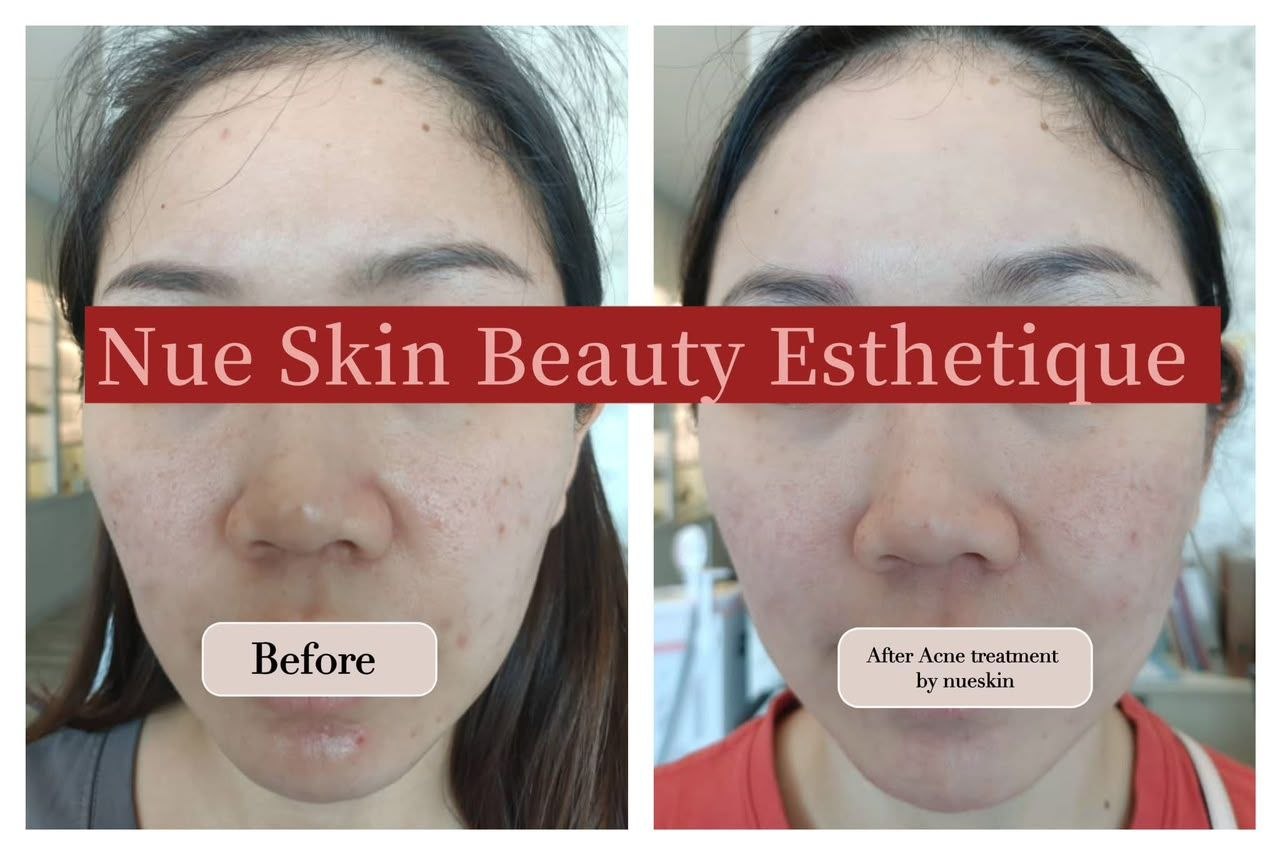Acne Treatment before and after — Nue Skin Beauty Esthetique