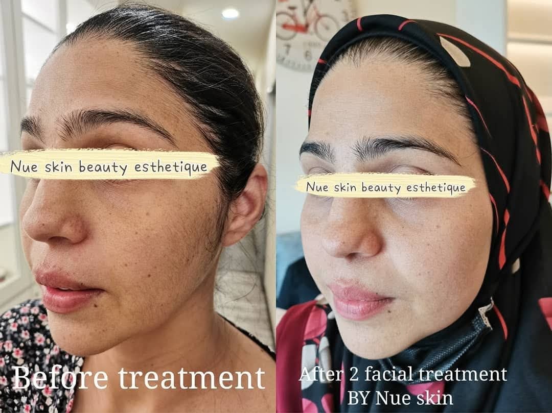 Facial Rejuvenation before and after — Nue Skin Beauty Esthetique