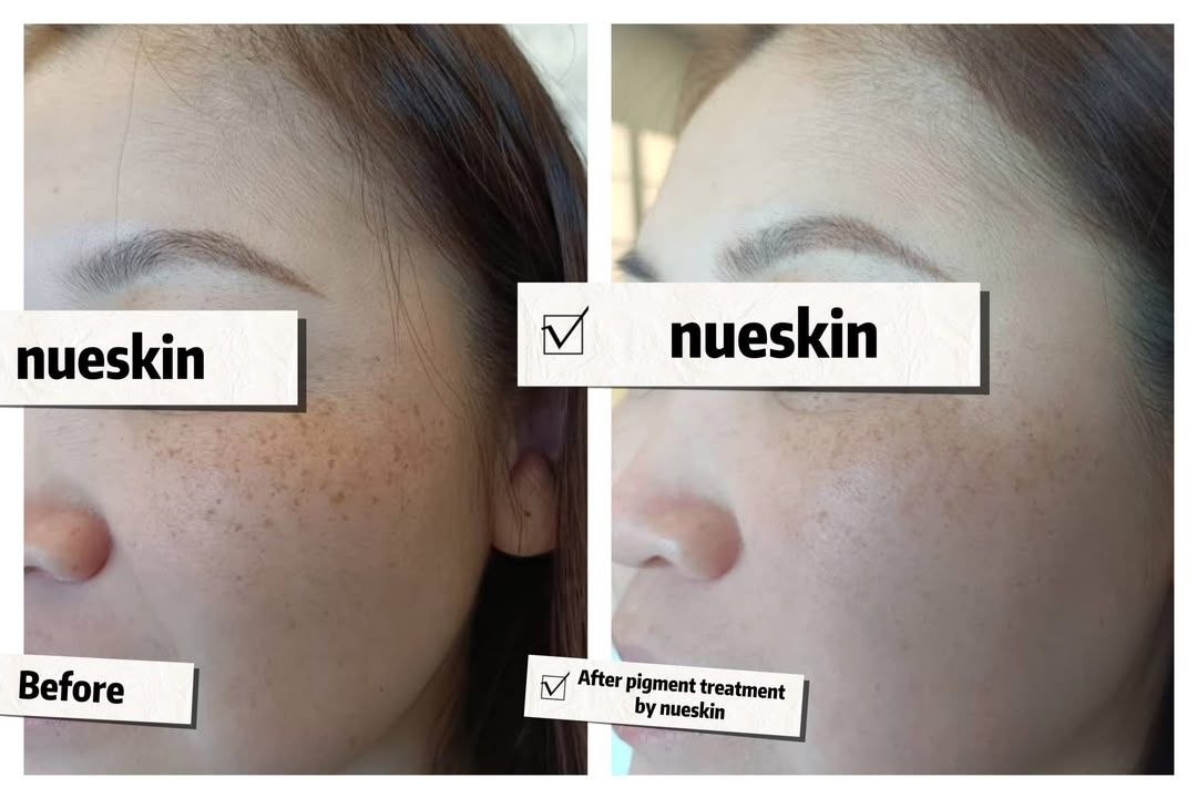 Pigment Treatment before and after — Nue Skin Beauty Esthetique