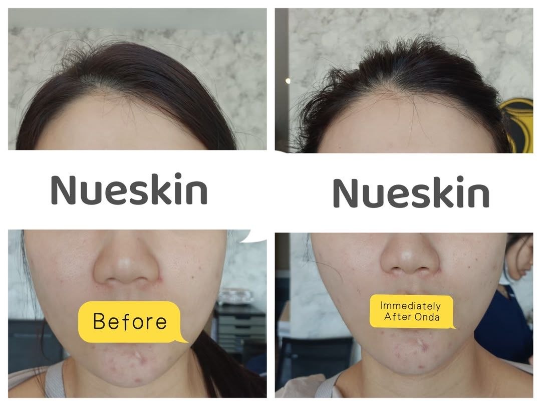 Face Contouring before and after — Nue Skin Beauty Esthetique