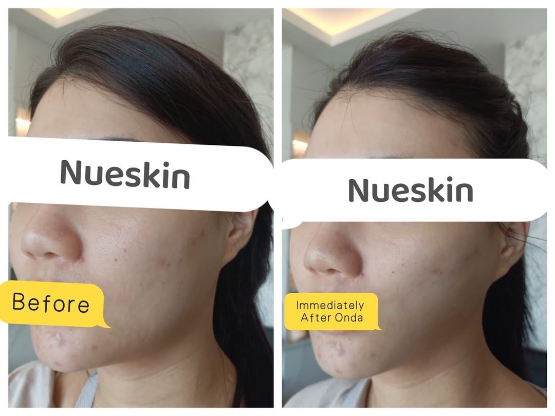 Face Contouring before and after — Nue Skin Beauty Esthetique
