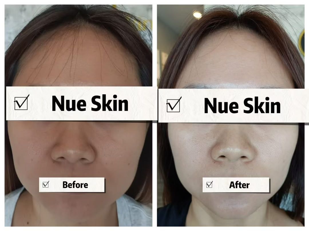 Facial Rejuvenation before and after — Nue Skin Beauty Esthetique