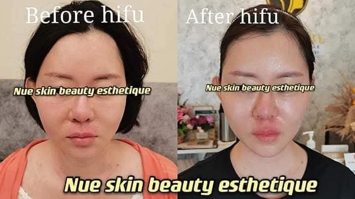 HIFU Lifting before and after — Nue Skin Beauty Esthetique