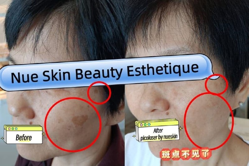 Client treatment result before and after — Nue Skin Beauty Esthetique