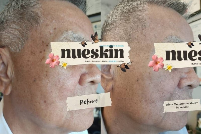 Client treatment result before and after — Nue Skin Beauty Esthetique