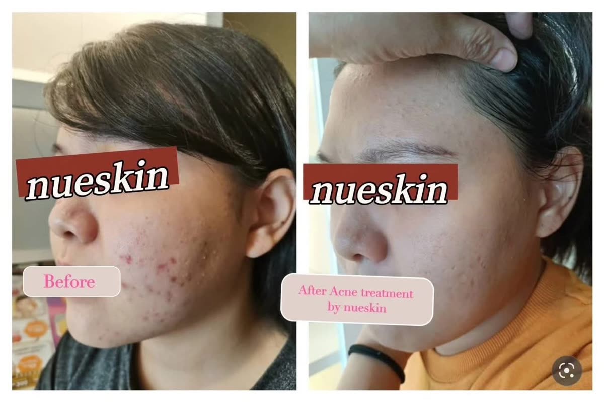 Client treatment result before and after — Nue Skin Beauty Esthetique
