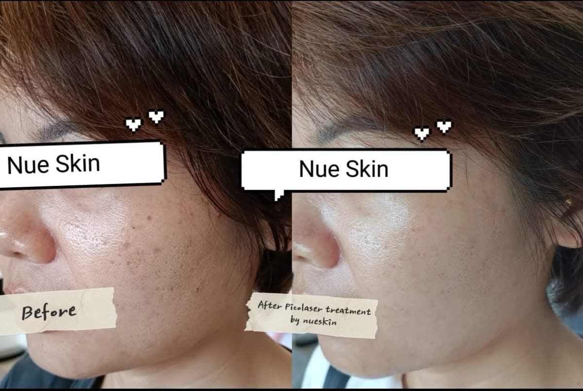 Client treatment result before and after — Nue Skin Beauty Esthetique