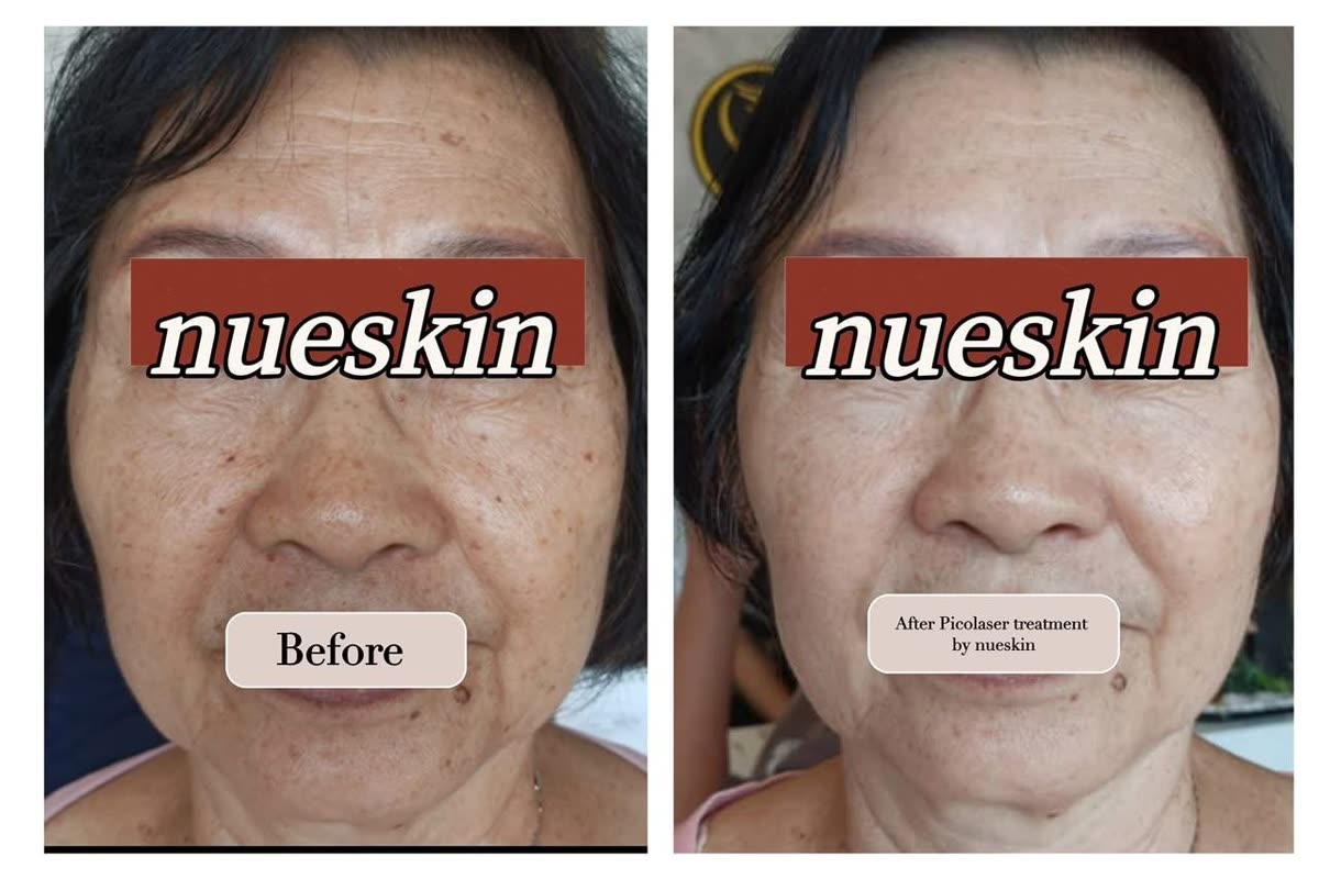 Client treatment result before and after — Nue Skin Beauty Esthetique