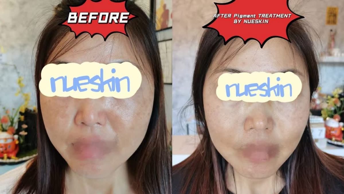 Client treatment result before and after — Nue Skin Beauty Esthetique