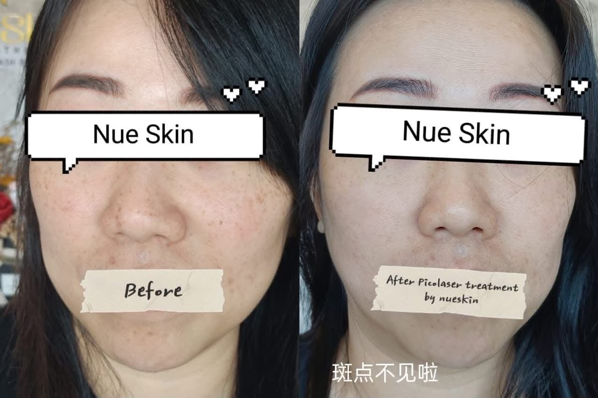 Client treatment result before and after — Nue Skin Beauty Esthetique