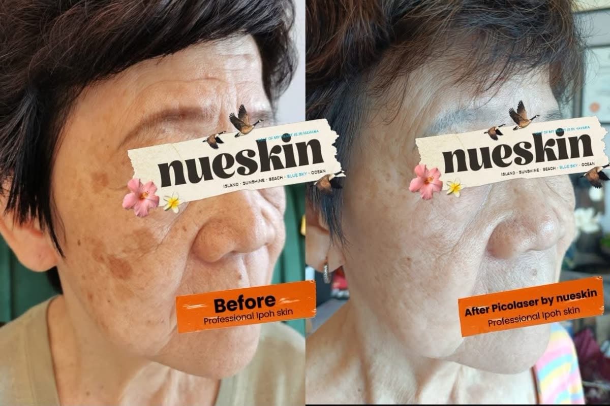 Client treatment result before and after — Nue Skin Beauty Esthetique