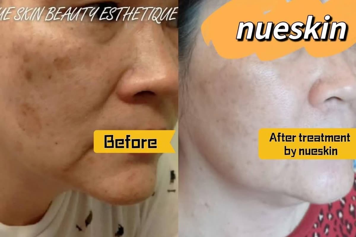 Client treatment result before and after — Nue Skin Beauty Esthetique