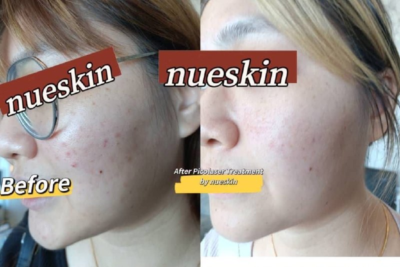 Client treatment result before and after — Nue Skin Beauty Esthetique