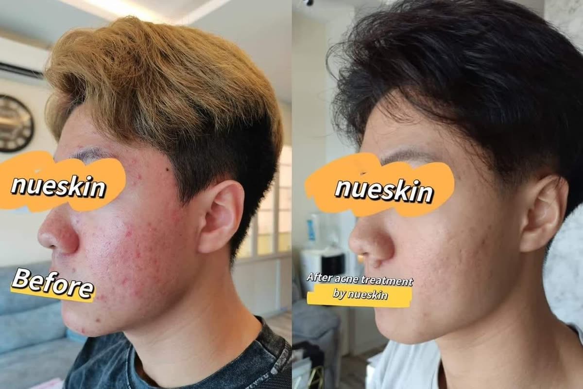 Client treatment result before and after — Nue Skin Beauty Esthetique