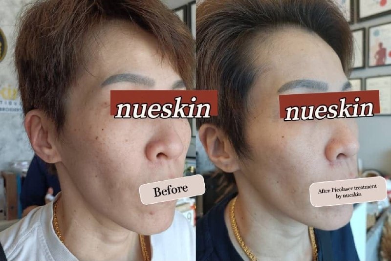 Client treatment result before and after — Nue Skin Beauty Esthetique