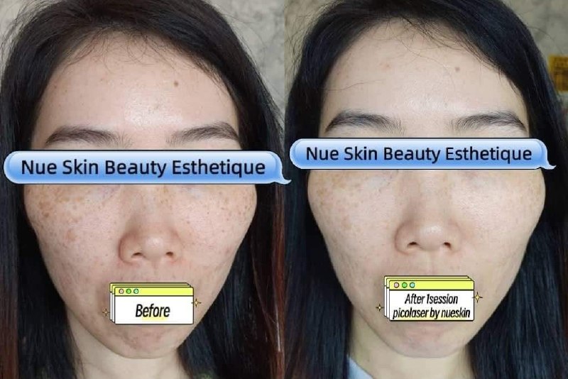 Client treatment result before and after — Nue Skin Beauty Esthetique