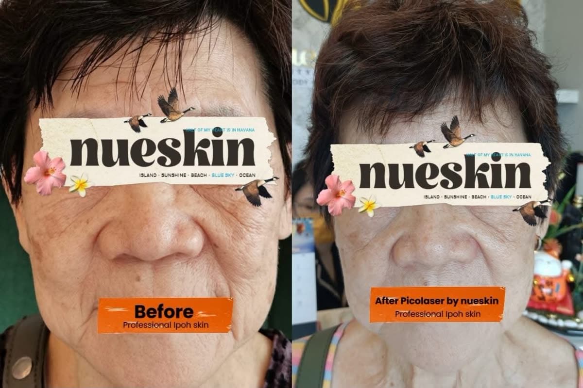 Client treatment result before and after — Nue Skin Beauty Esthetique