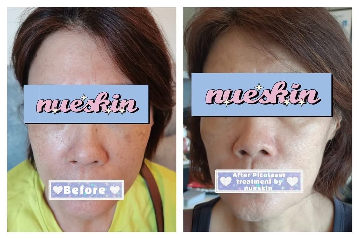 Client treatment result before and after — Nue Skin Beauty Esthetique