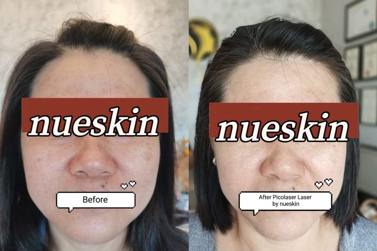 Client treatment result before and after — Nue Skin Beauty Esthetique