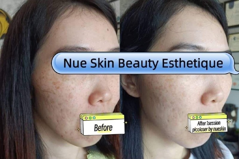 Client treatment result before and after — Nue Skin Beauty Esthetique