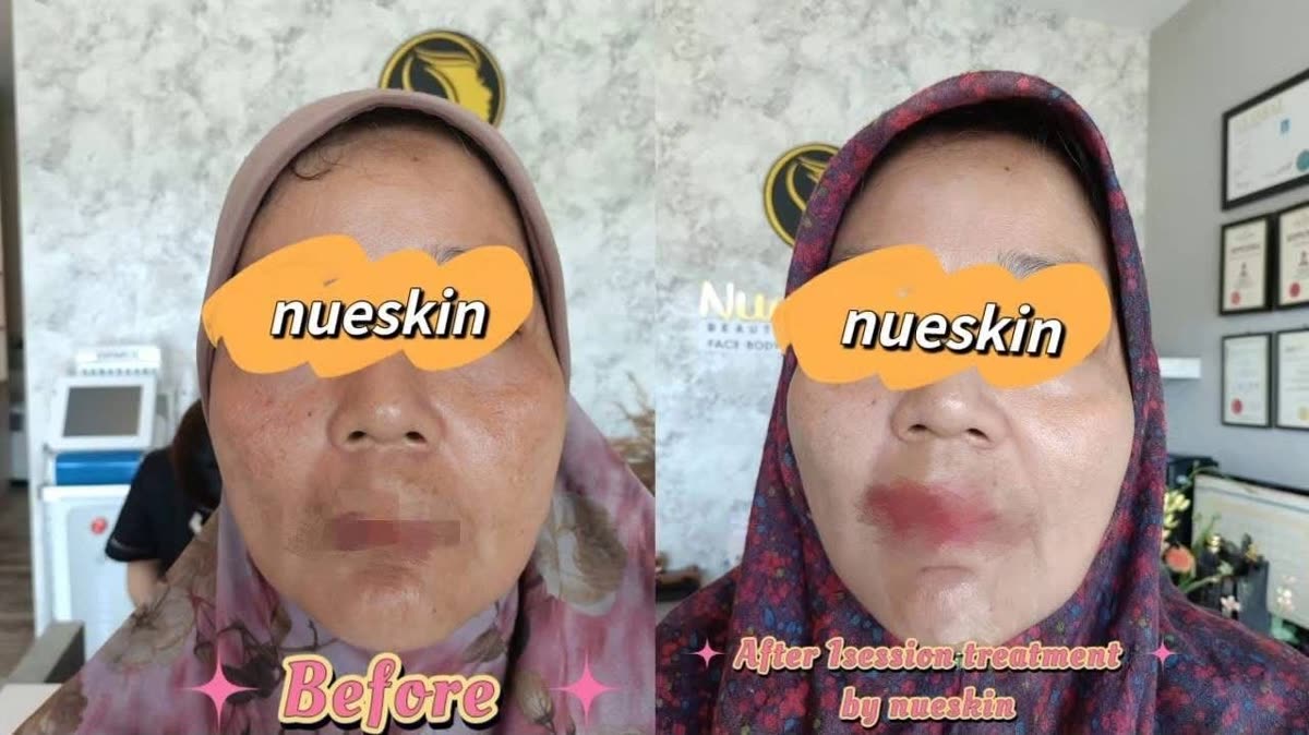 Client treatment result before and after — Nue Skin Beauty Esthetique