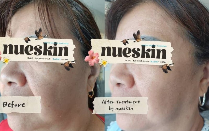 Client treatment result before and after — Nue Skin Beauty Esthetique