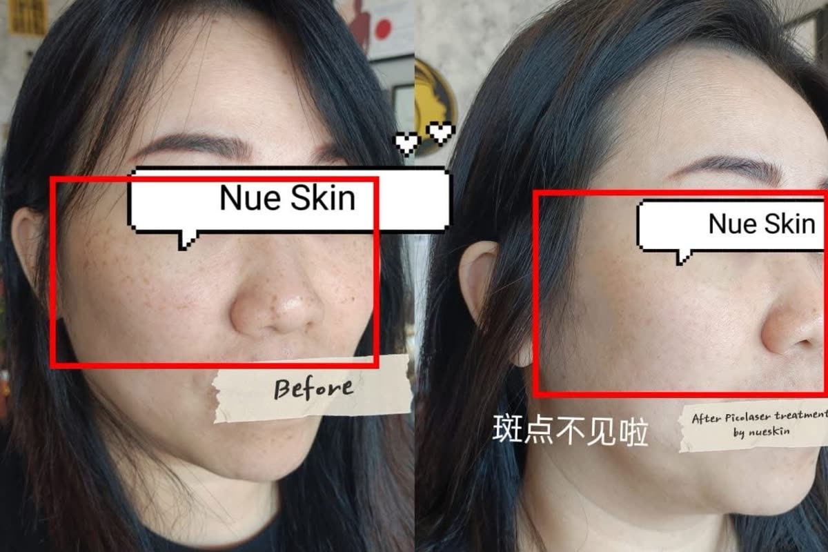 Client treatment result before and after — Nue Skin Beauty Esthetique