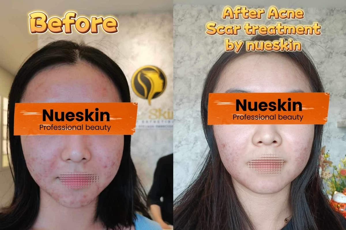 Client treatment result before and after — Nue Skin Beauty Esthetique