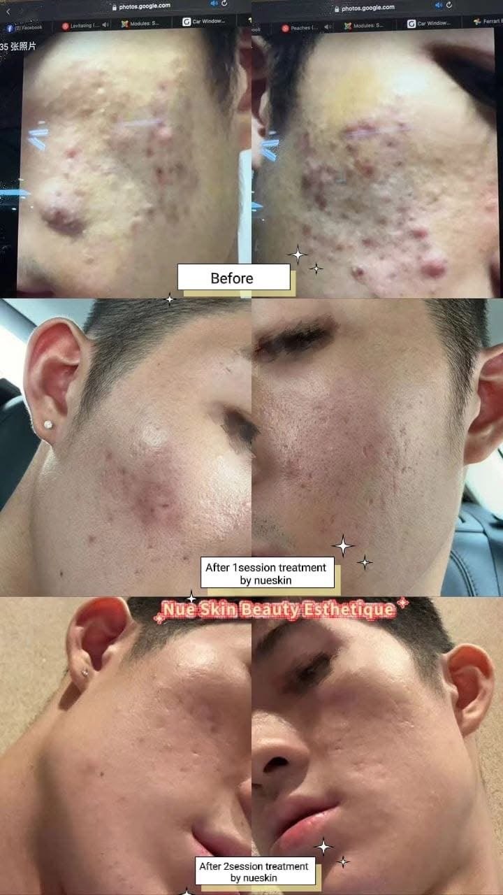 Client treatment result before and after — Nue Skin Beauty Esthetique