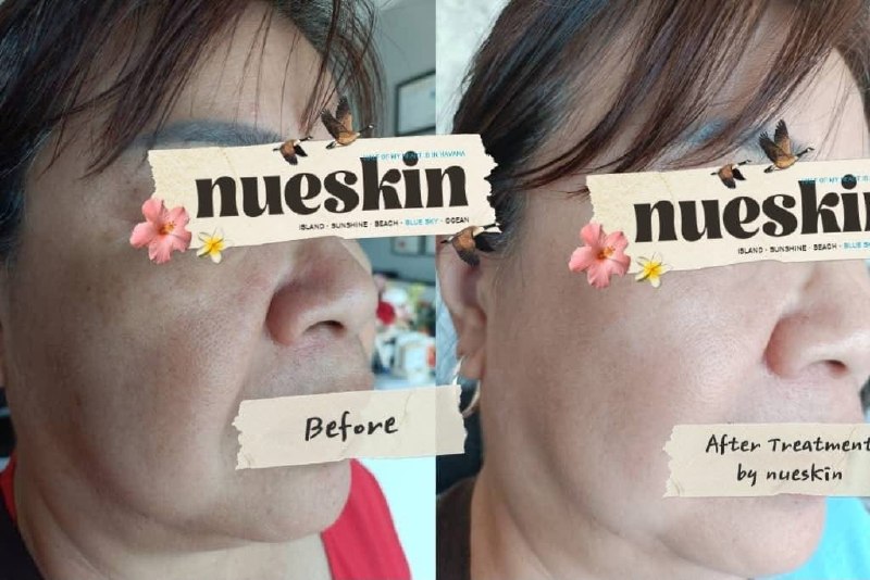 Client treatment result before and after — Nue Skin Beauty Esthetique